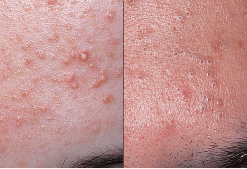 Controlling Acne